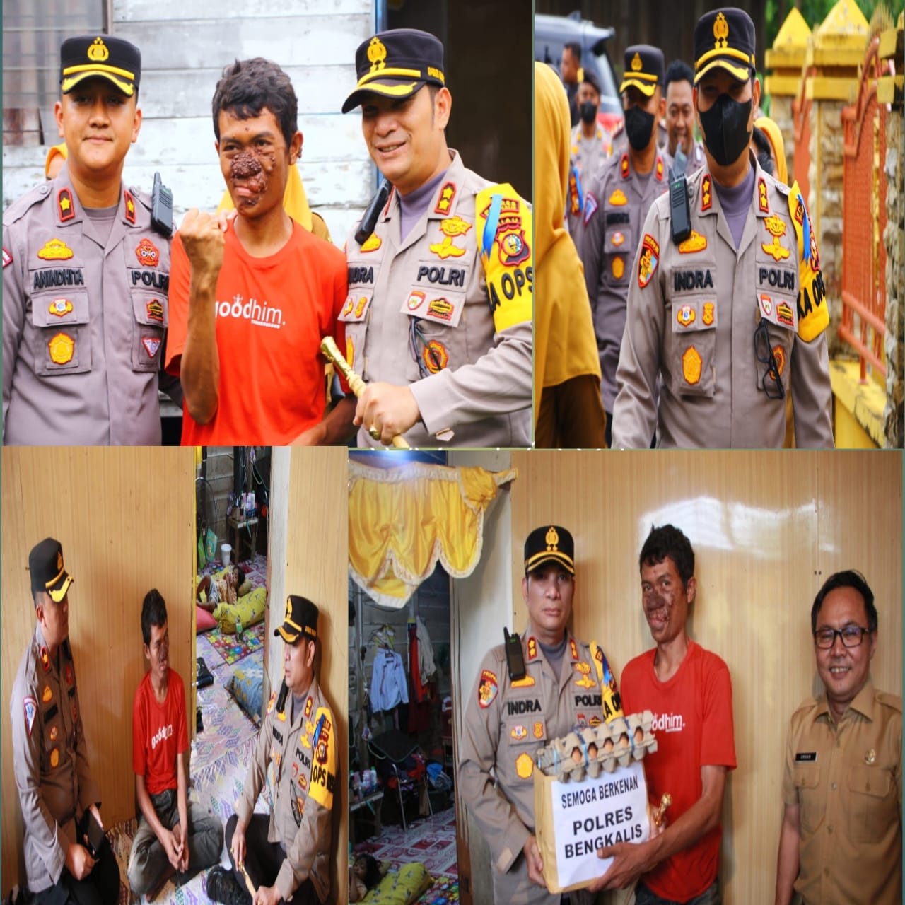 Kapolres Bengkalis, AKBP Indra Wijatmiko Bantu Penderita Penyakit Kanker Kulit Berobat ke Rumah Sakit